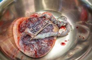 How To Deliver A Placenta After The Baby: Human Birth, Part 3