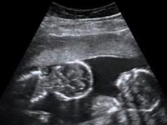 Twins and Breech Babies: Human Birth, Part 4