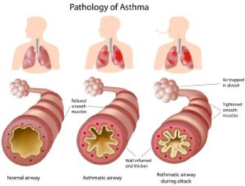 Asthma Off The Grid, Part 2: Treatments and Myths